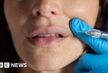 AI tool put to test sifting public views on botox and fillers